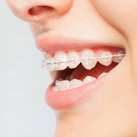 A closeup of a person wearing ceramic braces.