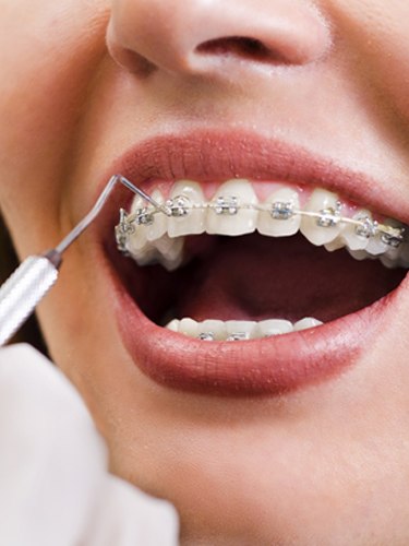 A woman having orthodontic work