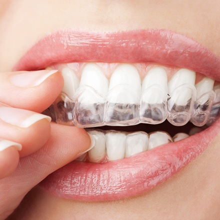 A woman wearing Invisalign