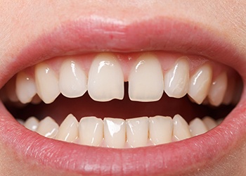 gaps between teeth for Invisalign in Chicago