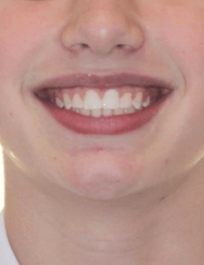 Class II Crowding Smile After