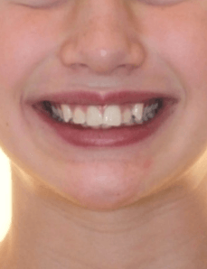 Class II Crowding Smile Before