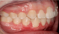 Class II Crowding Teeth After