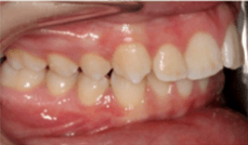 Class II Crowding Teeth Before