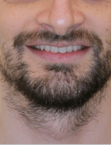 Class II + Deep Bite Smile After