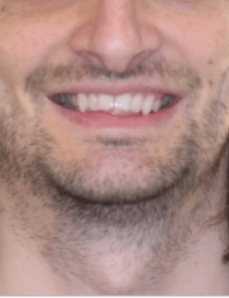 Class II + Deep Bite Smile Before