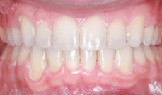 Class II + Deep Bite Teeth After