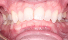 Class II + Deep Bite Teeth Before