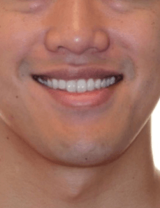 Class III Smile After
