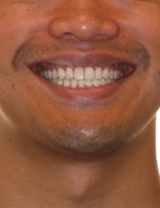 Class III Smile Before