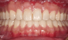 Class III Teeth After