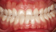 Class III Teeth Before