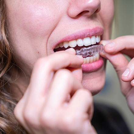 woman putting in clear aligners in South Loop (for FAQs section)