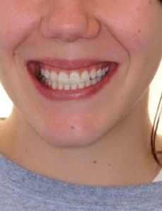 Gummy Smile Reduction Smile After