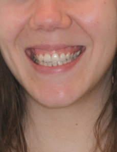 Gummy Smile Reduction Smile Before