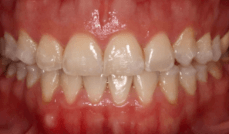 Gummy Smile Reduction Teeth After