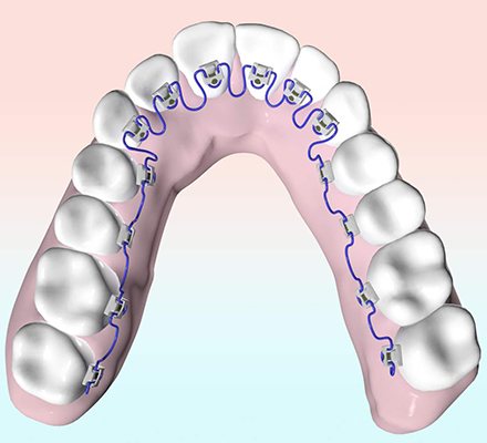 lingual braces illustration