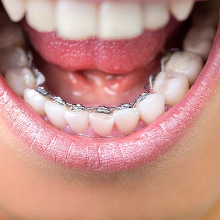 Lingual braces behind patient’s lower teeth