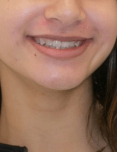 Missing Laterals Smile After