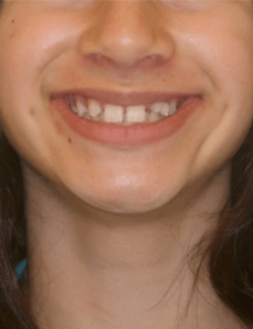 Missing Laterals Smile Before