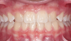 Missing Laterals Teeth After