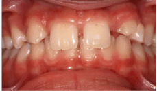 Missing Laterals Teeth Before