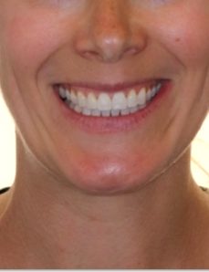 Narrow Arches / Crowding Smile After