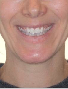 Narrow Arches / Crowding Smile Before