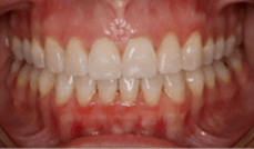 Narrow Arches / Crowding Teeth After