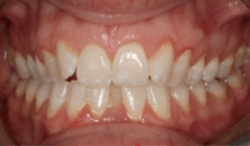 Narrow Arches / Crowding Teeth Before
