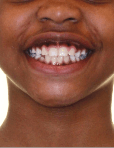 Phase 1 Crossbite Smile After