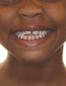 Phase 1 Crossbite Smile Before