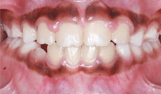 Phase 1 Crossbite Teeth After