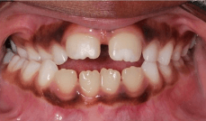 Phase 1 Crossbite Teeth Before