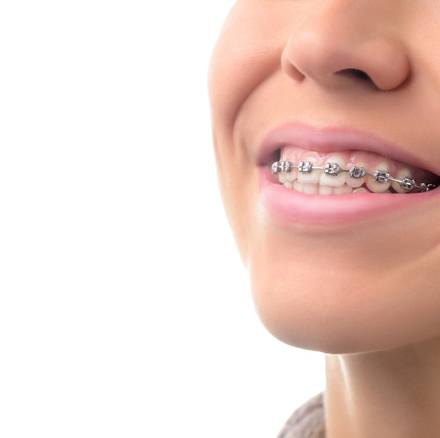 Traditional Braces, Orthodontic Treatment