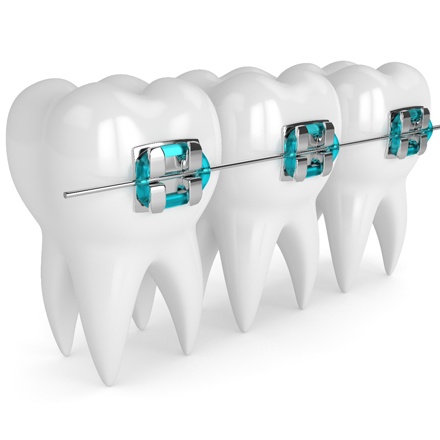 braces illustration